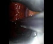 Anal surgery from chirurgie
