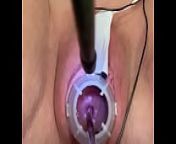 Painful electrosounding cervix from too big cervix pain