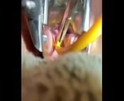 Inserting Foley into cervix from foley